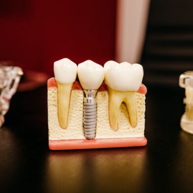 Cosa succede se non sostituiamo un dente che manca?