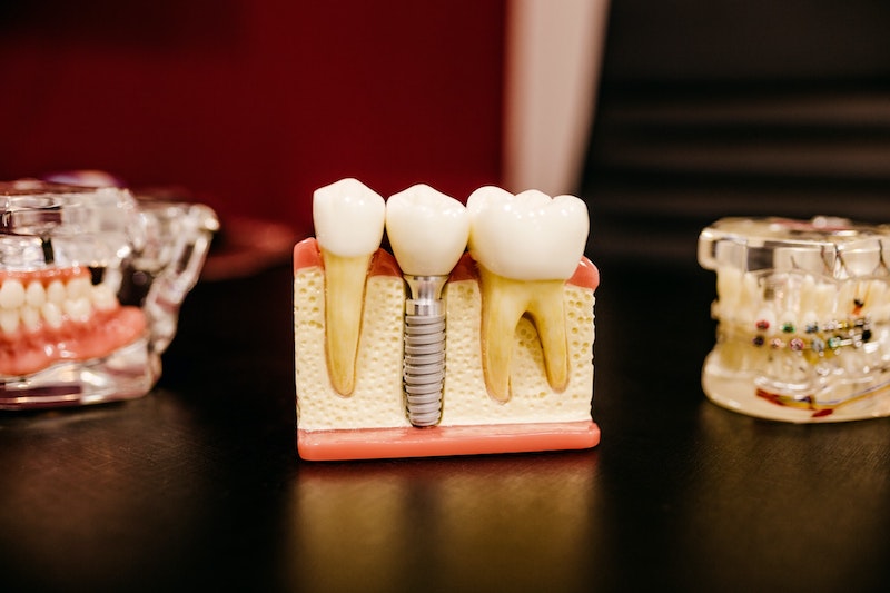 Cosa succede se non sostituiamo un dente che manca?